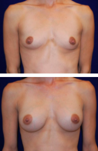 Breast Augmentation Before and After Photos