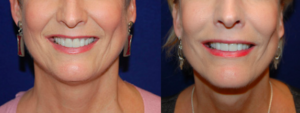 Facelift patient by Dr. Carpenter