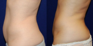 Liposuction patient of Dr. Carpenter