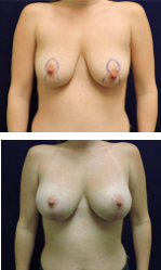 Carpenter breast lift patient