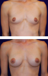 Carpenter breast lift patient 2