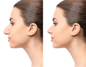 Young woman model before and after rhinoplasty