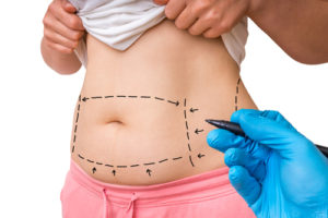 surgery doctor draw lines with marker on patient belly-img-blog