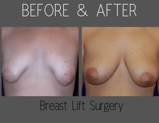 Before and After Breast Lift Surgery