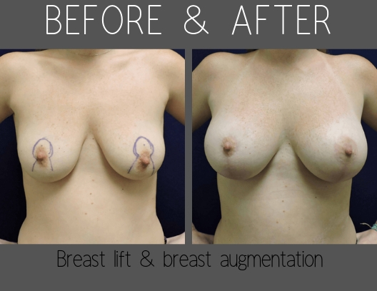 Before and After Breast Lift with Augmentation
