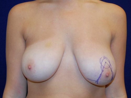 Breast Reduction in Dallas, TX Before Patient 2