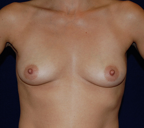 Breast Augmentation in Dallas, TX Before Patient 1