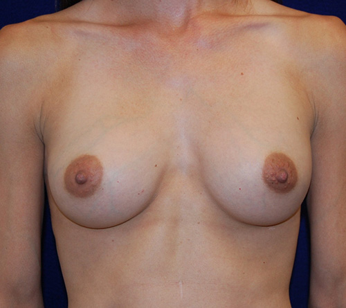 Breast Augmentation in Dallas, TX After Patient 2