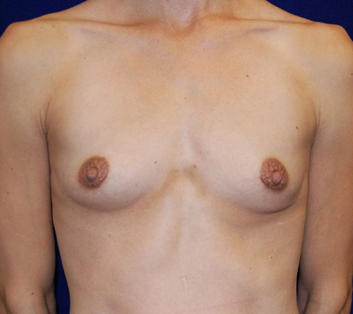 Breast Augmentation in Dallas, TX Before Patient 2