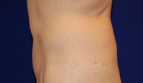 Tummy Tuck (Abdominoplasty) in Dallas, Texas After Patient 2