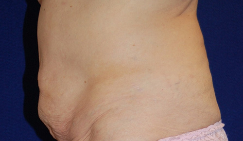 Tummy Tuck (Abdominoplasty) in Dallas, Texas Before Patient 2