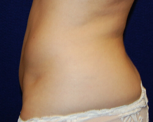 Liposuction in Dallas, TX After Patient 2