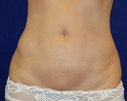 Liposuction in Dallas, TX After Patient 1