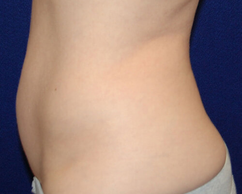 Liposuction in Dallas, TX Before Patient 2