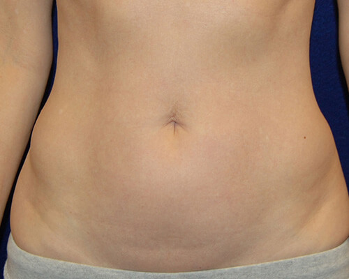 Liposuction in Dallas, TX Before Patient 1