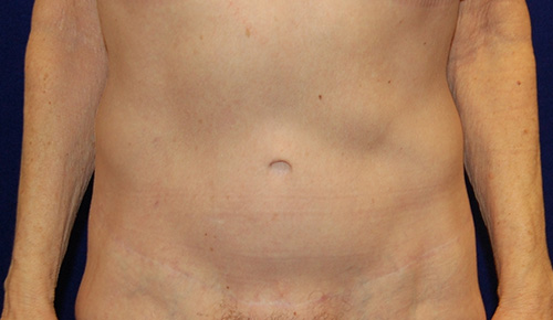 Tummy Tuck (Abdominoplasty) in Dallas, Texas After Patient 1