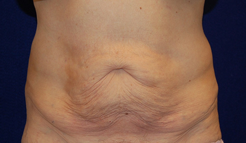 Tummy Tuck (Abdominoplasty) in Dallas, Texas Before Patient 1