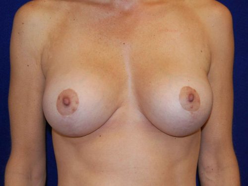 Breast Lift (Mastopexy) in Dallas, TX After Patient 2