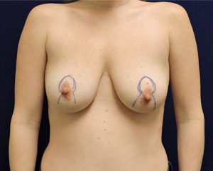 Breast Lift (Mastopexy) in Dallas, TX Before Patient 1