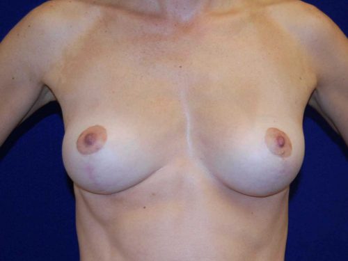 Breast Lift (Mastopexy) in Dallas, TX Before Patient 2