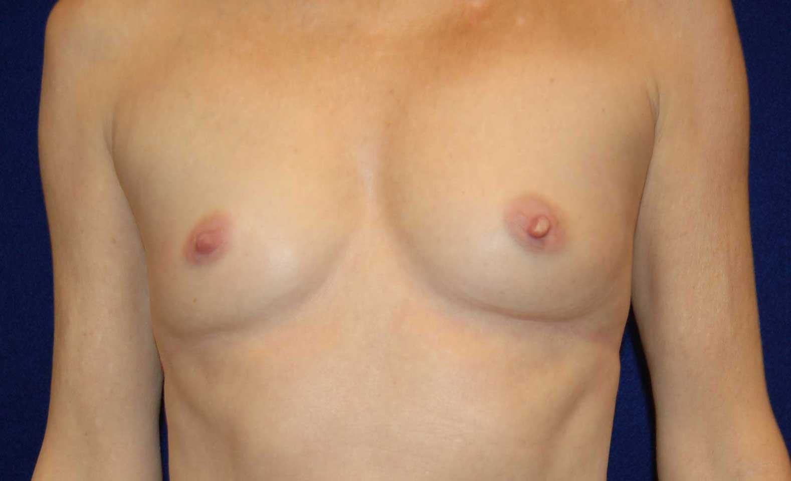 Breast Augmentation in Dallas, TX Before Patient 3