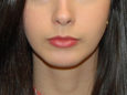 Chin Augmentation After Patient Thumbnail 1