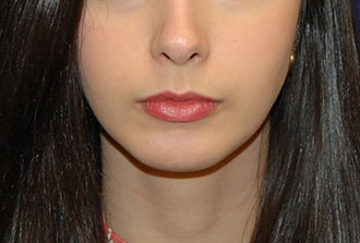 Chin Augmentation After Patient 1