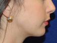Chin Augmentation After Patient Thumbnail 2