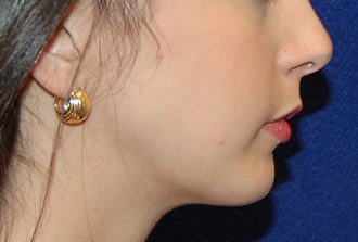 Chin Augmentation After Patient 2