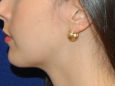 Chin Augmentation After Patient Thumbnail 3
