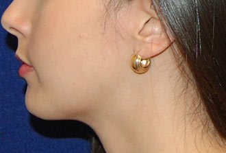 Chin Augmentation After Patient 3