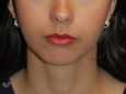 Chin Augmentation Before Patient Thumbnail 1