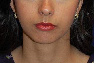Chin Augmentation Before Patient 1
