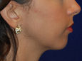 Chin Augmentation Before Patient Thumbnail 2