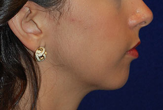 Chin Augmentation Before Patient 2
