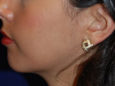 Chin Augmentation Before Patient Thumbnail 3