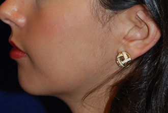 Chin Augmentation Before Patient 3