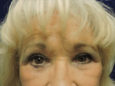 Face After Patient Thumbnail 2