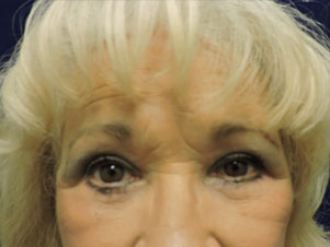 Face After Patient 2