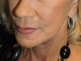 Face After Patient Thumbnail 3