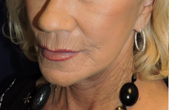 Face After Patient 3