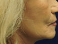 Face After Patient Thumbnail 4