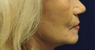 Face After Patient 4
