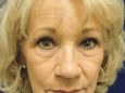 Face Before Patient Thumbnail 1