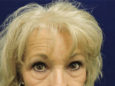 Face Before Patient Thumbnail 2