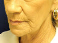 Face Before Patient Thumbnail 3