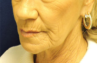 Face Before Patient 3