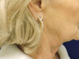 Face Before Patient Thumbnail 4