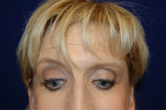 Eyelid Surgery in Dallas, TX After Patient 2