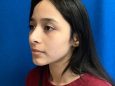Rhinoplasty After Patient Thumbnail 2